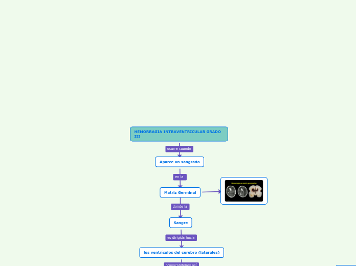 HEMORRAGIA INTRAVENTRICULAR GRADO III