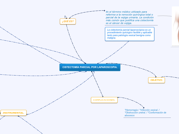 CISTECTOMÍA PARCIAL POR LAPAROSCOPIA.